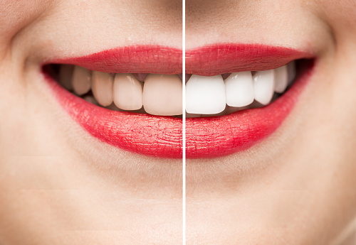 Teeth-whitening-in-mallapur