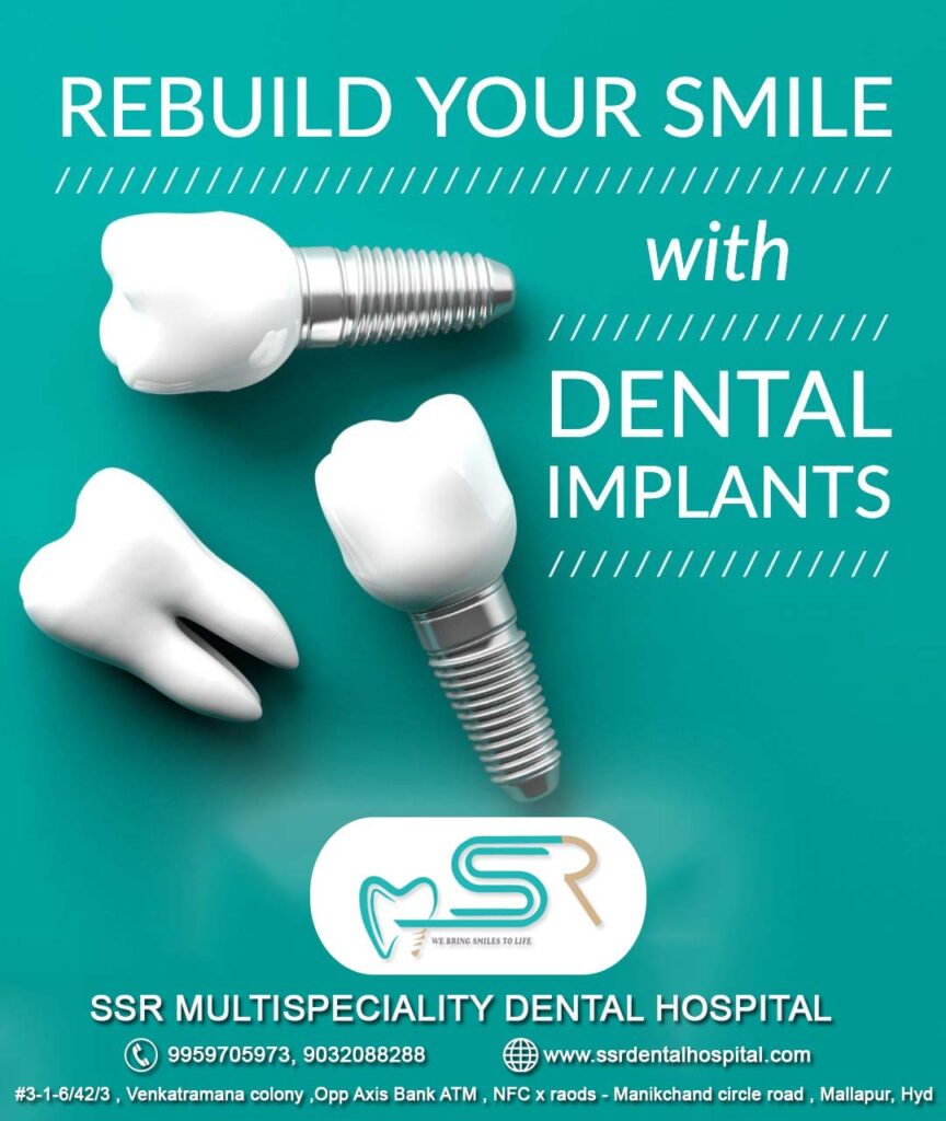 dental-implants-in-mallapur