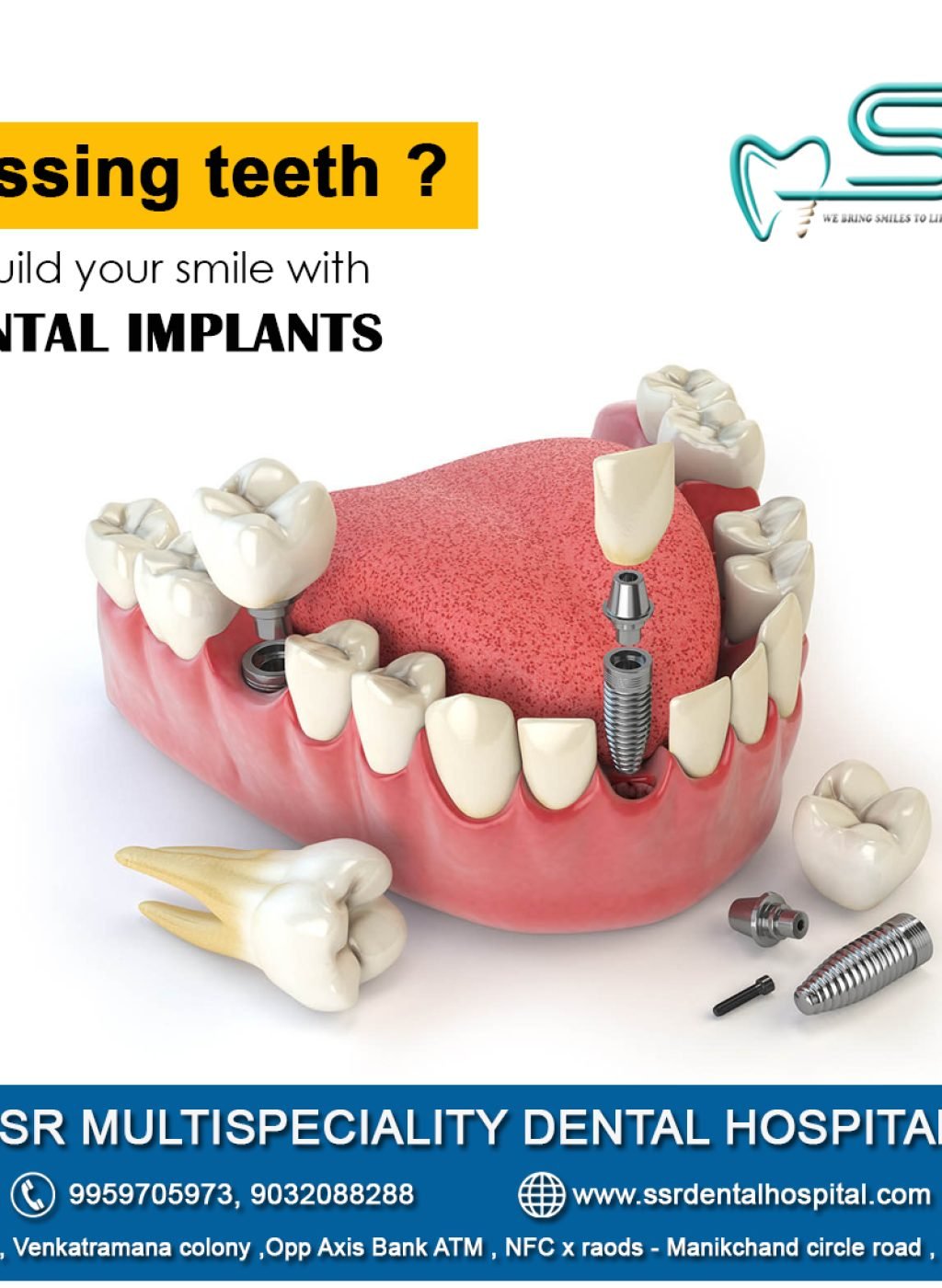 detantal-implants dentals-implants-in-mallapur